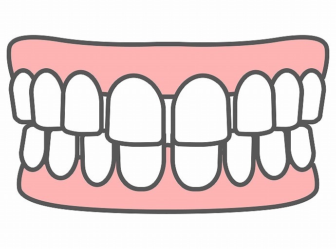 すきっ歯（空隙歯列）