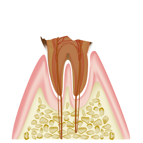 歯の根だけが残った状態のむし歯（C4）