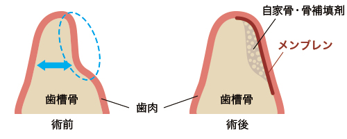 骨のない症例に対してのアプローチ