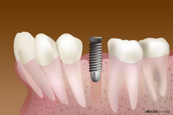 インプラント一次手術