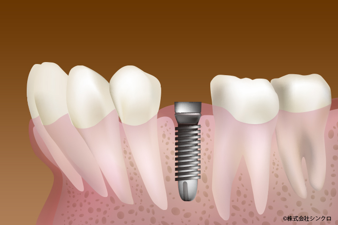 インプラント二次手術