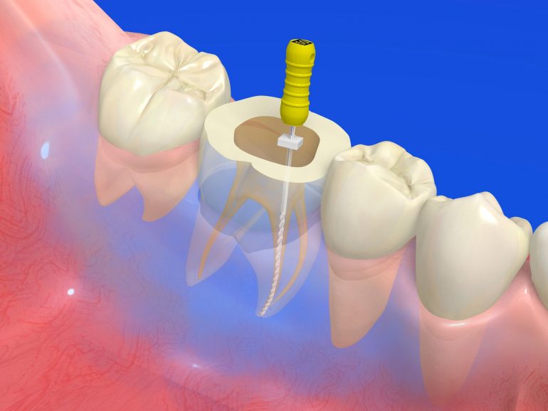 根管治療の重要性