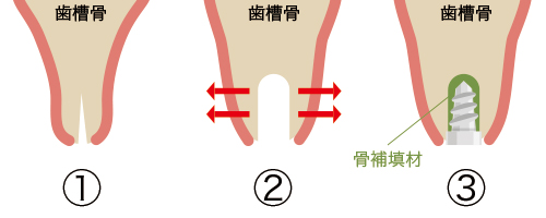 骨のない症例に対してのアプローチ