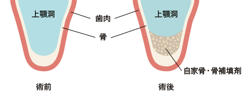 骨のない症例に対してのアプローチ